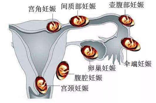 宮外孕不可怕，醫生提醒及早診斷及時治療