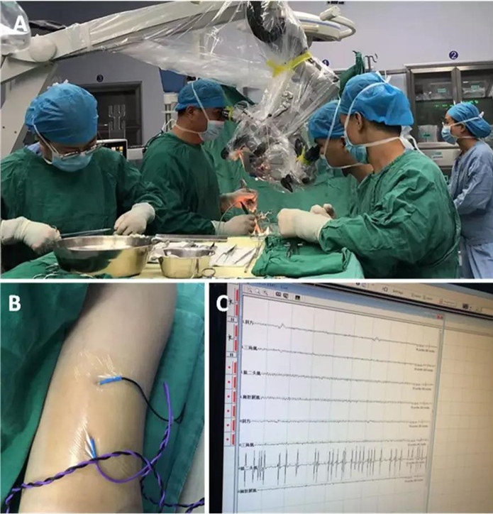 頸髓內巨大腫瘤，挑戰手術“禁區”成功