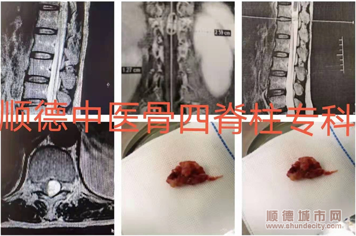 他的苦口婆心，讓腫瘤病人獲得了再次站起來的機會