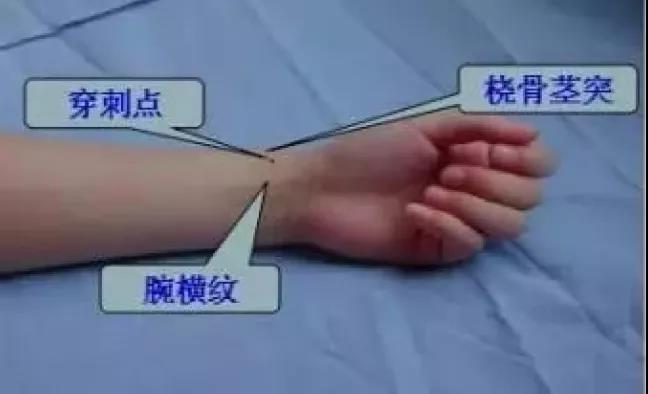 “全腦血管造影術(shù)”隨做隨走，獲患者好評