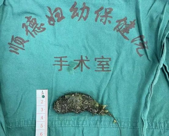 孩子腹痛發熱，元兇竟是拳頭般大的毛發團……