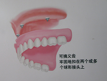 種牙沒有年齡上限，每顆1萬2嚇退眾人