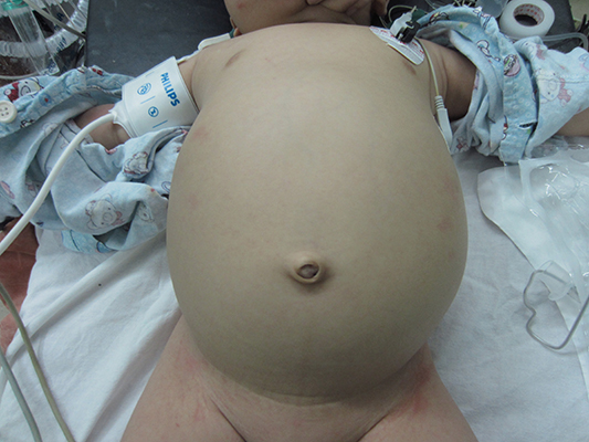 女嬰患先天性膽總管囊腫，腹大如西瓜