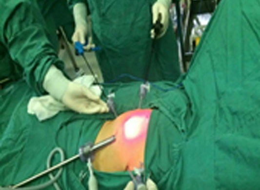 3歲小孩反復腹病，8小時手術(shù)解除頑疾