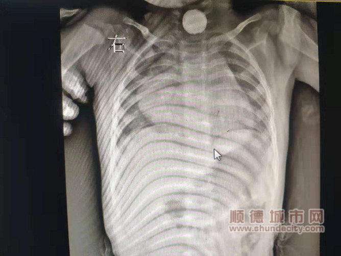 電池被卡在了喉嚨往下的食道中.png