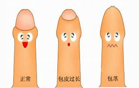 小孩包皮過長(zhǎng)？醫(yī)生提醒不要“一刀切”