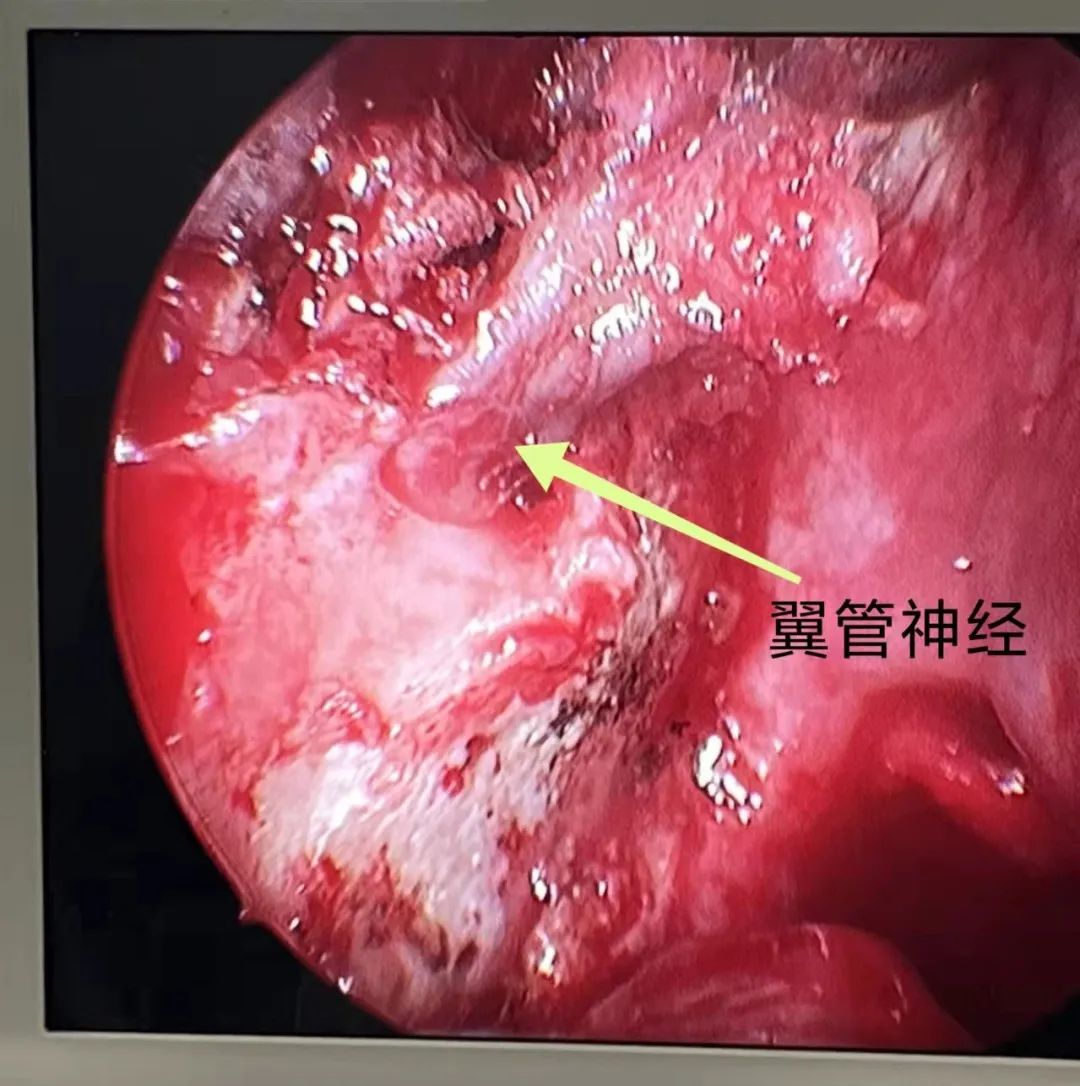 術中鼻內鏡下顯示右側鼻腔翼管位置.jpg