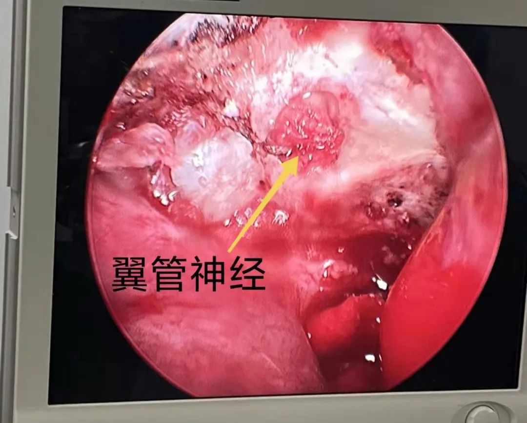 術中鼻內鏡下顯示左側鼻腔翼管位置.jpg
