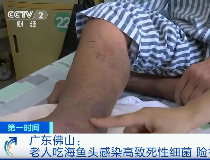 央視財經關注順德三院醫治病例，患者險被截肢