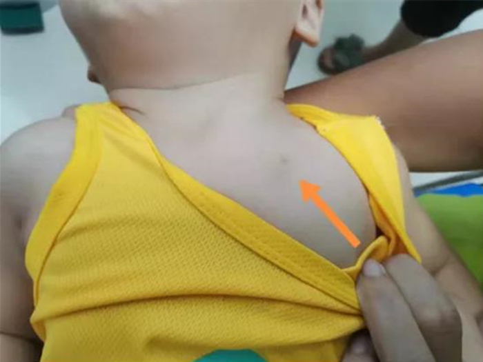 孩子胸壁有個不痛不癢的腫物？不切后悔！